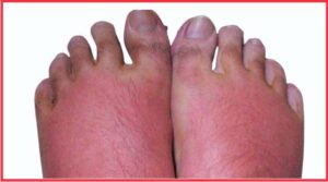 Best Shoes for Burning Feet